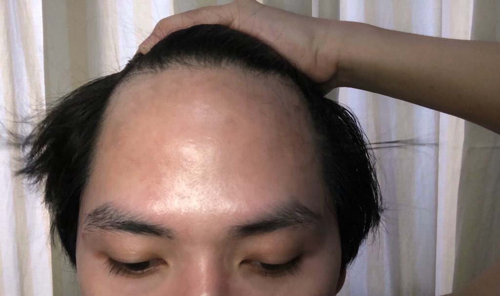 [A THREAD]So I’m trying my friend’s suggestion—Minoxidil. I want to share with you my hairloss journey & how will this product help me. Week 1: I’ve never thought that I’ll be experiencing this. At 1st, I was too indenial that Im getting balder everyday. But fck it, laban!  https://twitter.com/theneilcutter/status/1283018644088254464