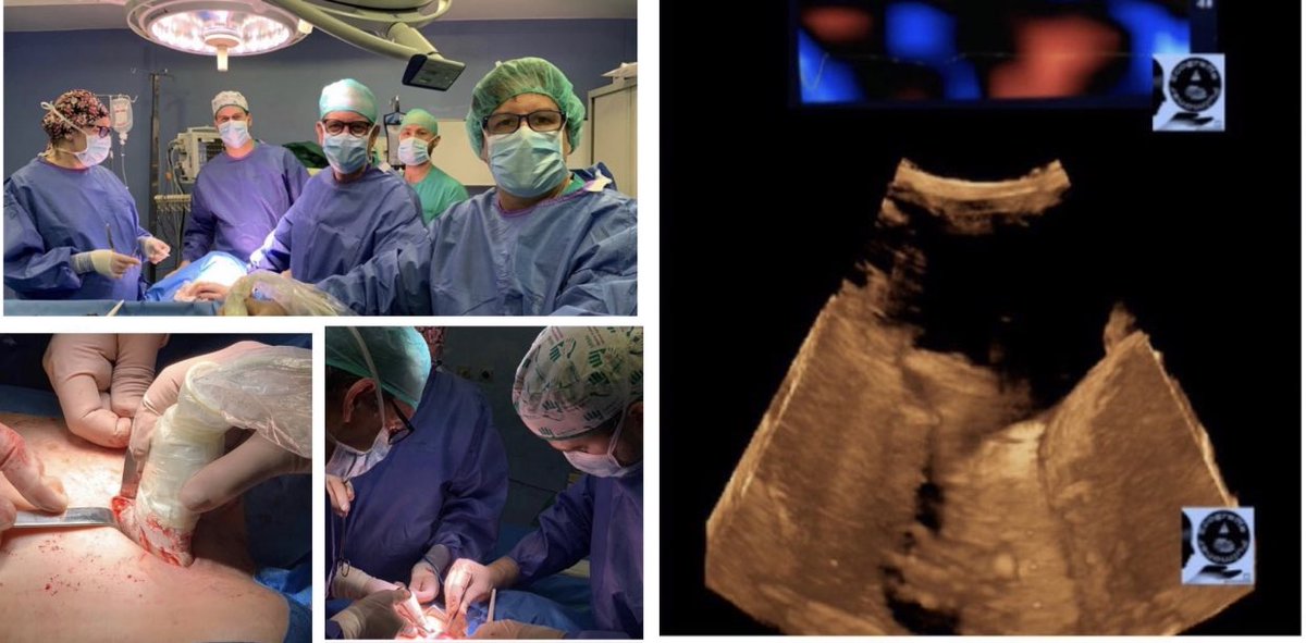 USAnesthesia's tweet photo. Cirugía Torácica guiada por Ecografía Cardio-Pulmonar Avanzada en el Hospital Vithas La Milagrosa de Madrid!! @Vithas @HospLaMilagrosa 
Dr.Garrido - Dr.Cidranes 
ICEBERG PROTOCOL in Real Time
#POCUS #Madrid #Spain #chamberi #surgeryteam #advancedultrasound 
#crticalcare https://t.co/UoLoIqV1jm