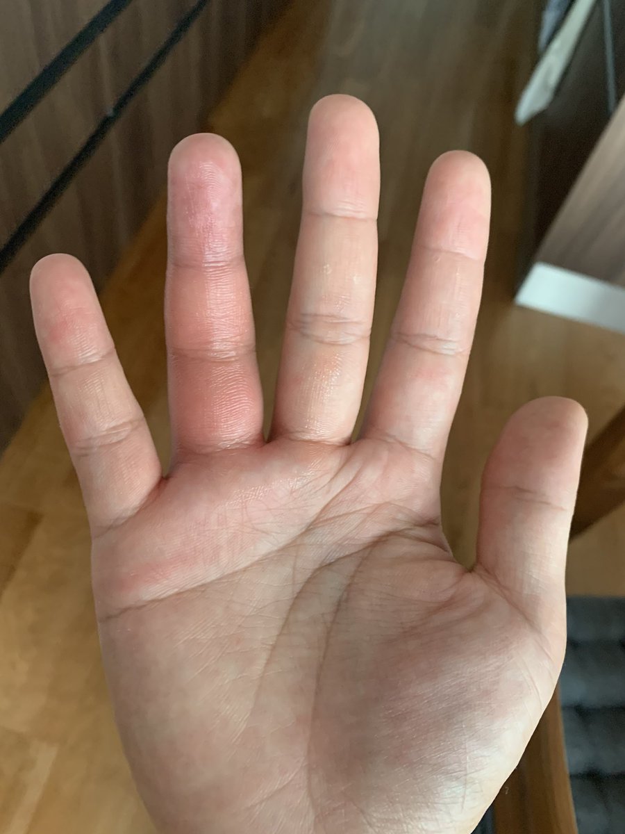 森川裕樹 No Twitter チクッ めっちゃ痛くて 始め竹のささくれが刺さったかと思ったけど みるみる腫れていくから よーく竹を見てみると 竹に穴が空いていて 中に虫がいました 竹の穴 虫 刺された って検索したらこいつでした