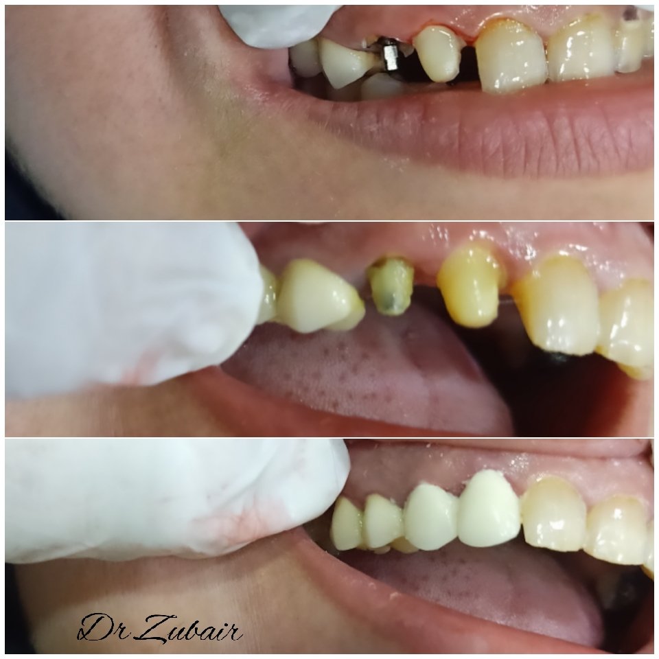 DrZubairAhm's tweet image. Patient with fracture and decayed canine and lateral Incisor !
I did root canal them metal post and then pt opted for porcelain crown ! 
#PostandCore #DentalSmile #dentistry #Dentist