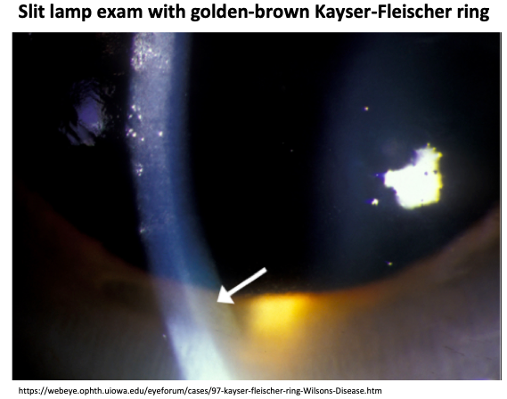 Detecting Wilson's disease through the eyes