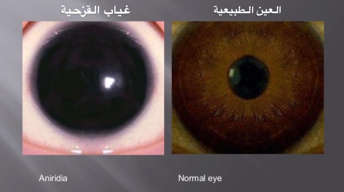 AlbakriAmani's tweet photo. اليوم أستمتعنا بندوة علمية عالمية حول اعتلال يصيب العين يُدعى Aniridia وهو عبارة عن "غياب قزحية العين" 
يظهر للأهالي على صورة "رأرأة" اهتزاز لا ارادي في العين او شكل بؤبؤ العين اكبر من الطبيعي #اماني_عيون_الاطفال #تغريدة_في_تخصصي #القزحية https://t.co/8ooQqO5FWy
