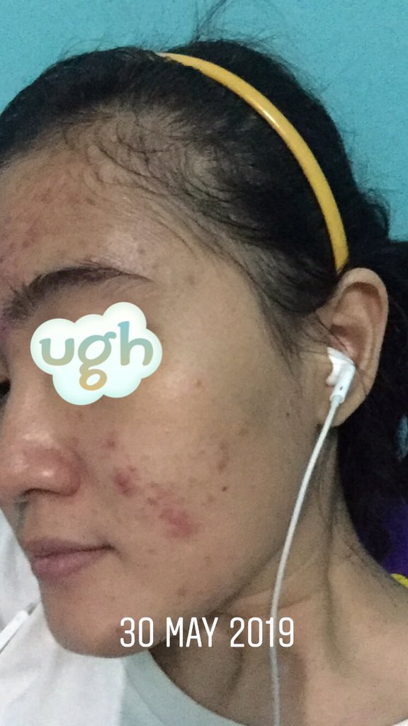 sprklingstorm's tweet photo. Acne stories &amp; skincare journey a THREAD 
.
. https://t.co/LscIPM0MZS