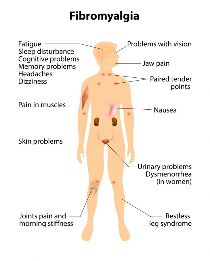 In the current study we examined the whole mitochondrial DNA in a large group of chronic pain patients. We found one gene associated with Fibromyalgia, especially in women. We also found evidence that this gene reduces energy production.