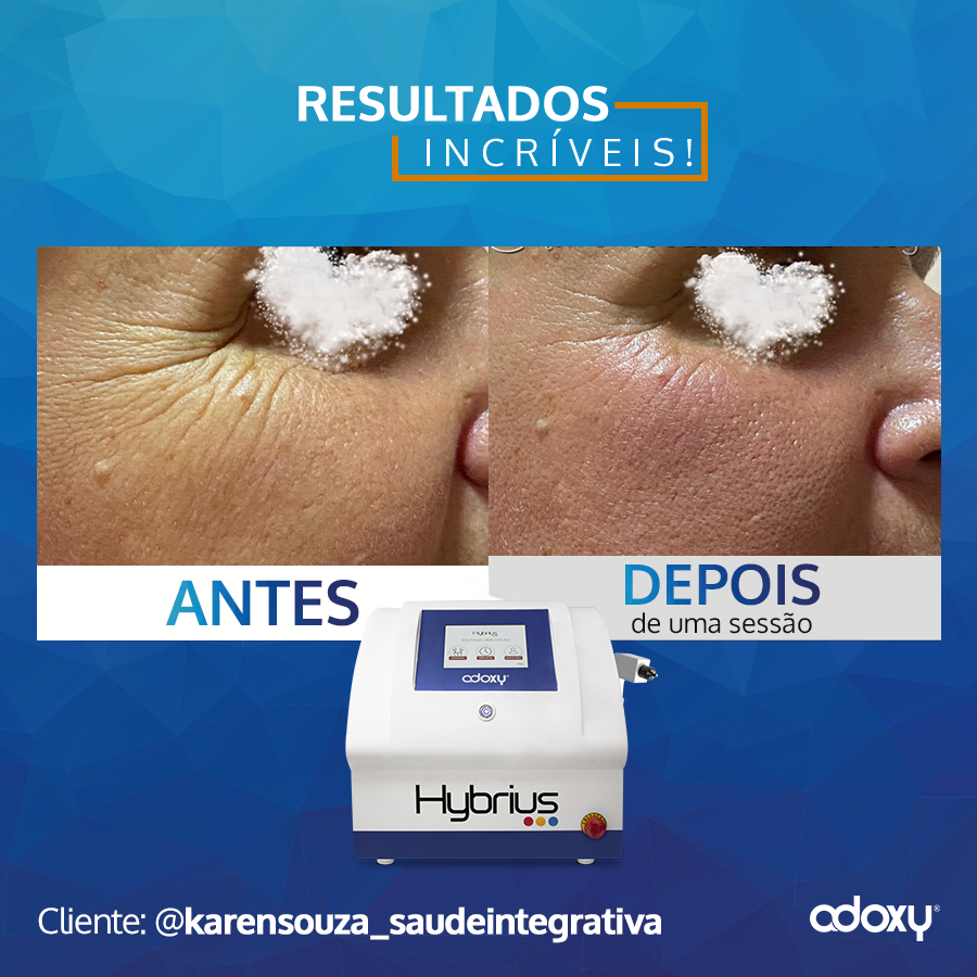 Adoxy on X: "Esse é o resultado do Hybrius após uma sessão. É isso que o seu paciente espera, resultados REAIS e IMPACTANTES desde a primeira sessão. Entre em contato conosco e