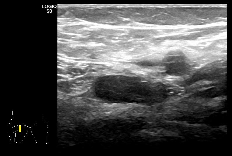 Bursitis del iliopsoas.
Mujer de 32 años, sana. Súbito dolor en región inguinal sin compromiso sistémico tras sobresfuerzo físico. Impotencia funcional.
Se drenaron 12 cc de líquido mecánico con resolución completa de la clínica.
<a href="/ecoserser/">ECOSER</a>