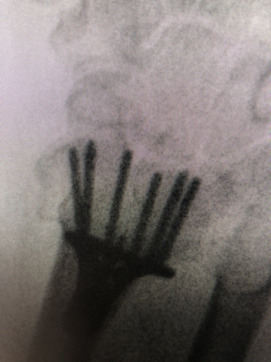 Quick tip: 
Lamina spreader for distal radius fractures. Radial inclination, Radius impingement into...