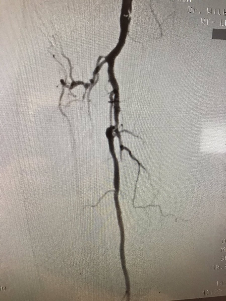 WilliamWuHVC's tweet photo. @SAIFSanAntonio  below ankle intervention for critical limb ischemia.
 83 years old gentle man with hx of cad , htn dm presented to critical limb  ischemia .  He was found to have total occlusion of AT, PT and 80% stenosis at origin of peroneal . https://t.co/ZPofUwwHYl