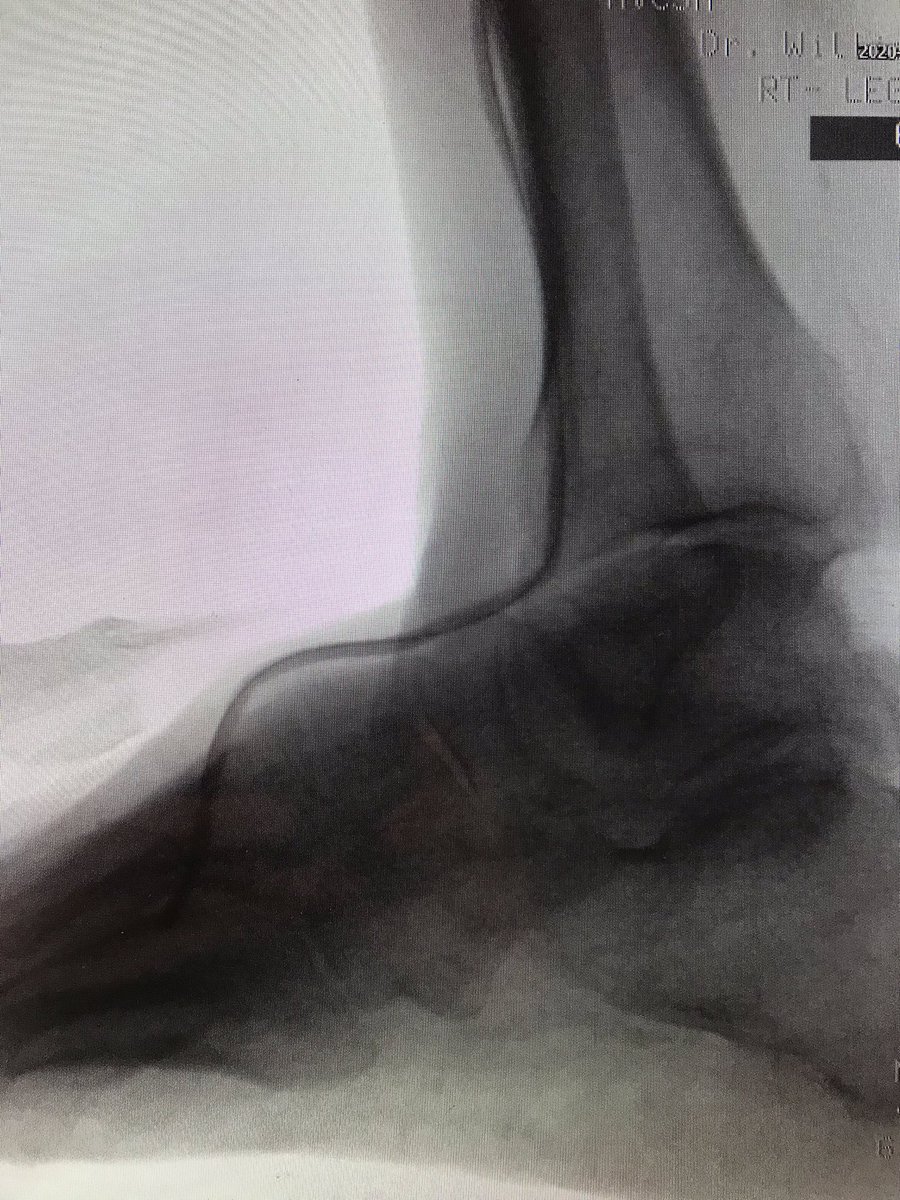WilliamWuHVC's tweet photo. We performed atherectomy and balloon angioplasty to PT , planta arc, angioplasty tonAT, dorsal pedis and peroneal artery. He did well. https://t.co/ob9gl9CHcc