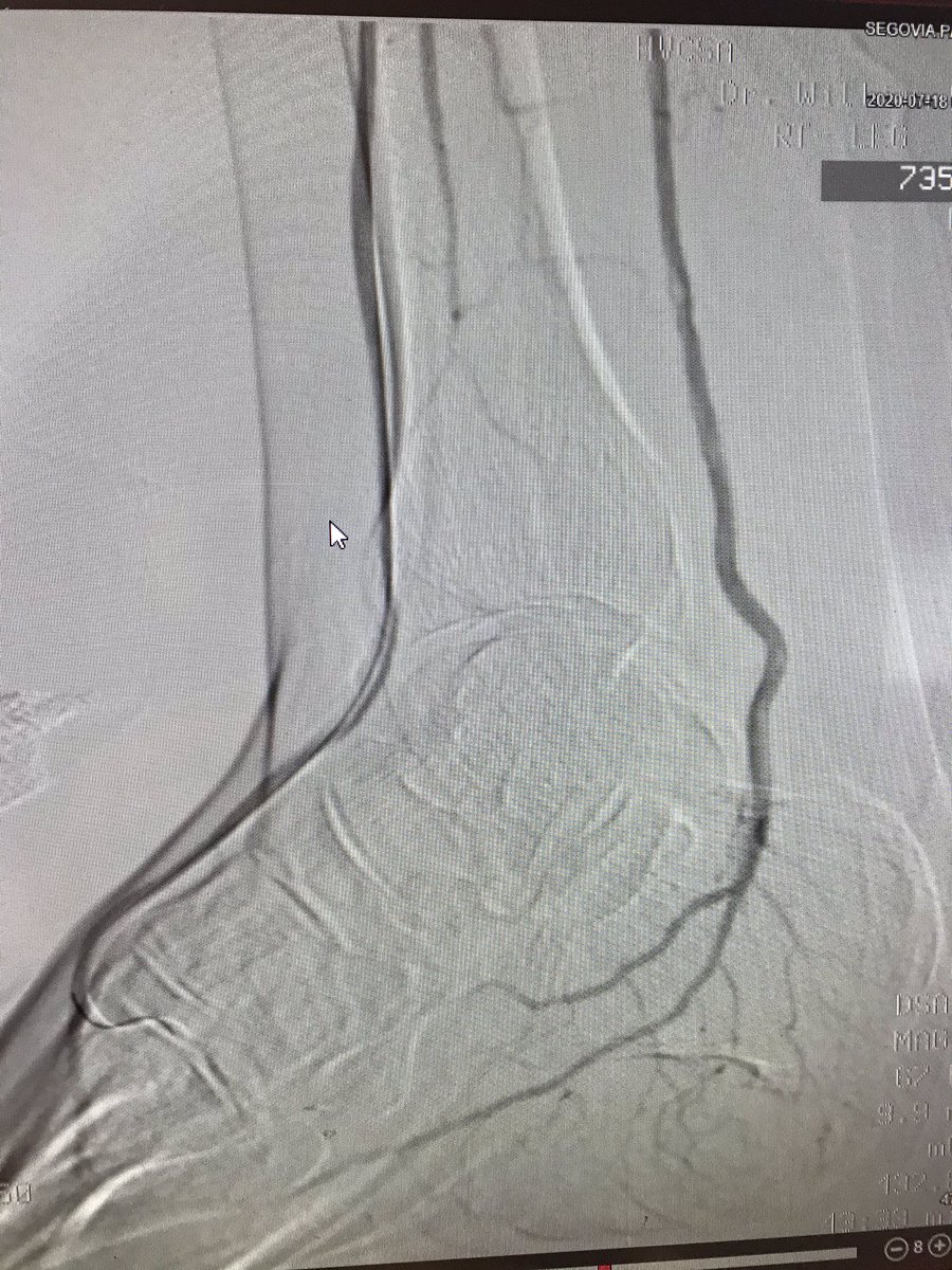 WilliamWuHVC's tweet photo. We performed atherectomy and balloon angioplasty to PT , planta arc, angioplasty tonAT, dorsal pedis and peroneal artery. He did well. https://t.co/ob9gl9CHcc