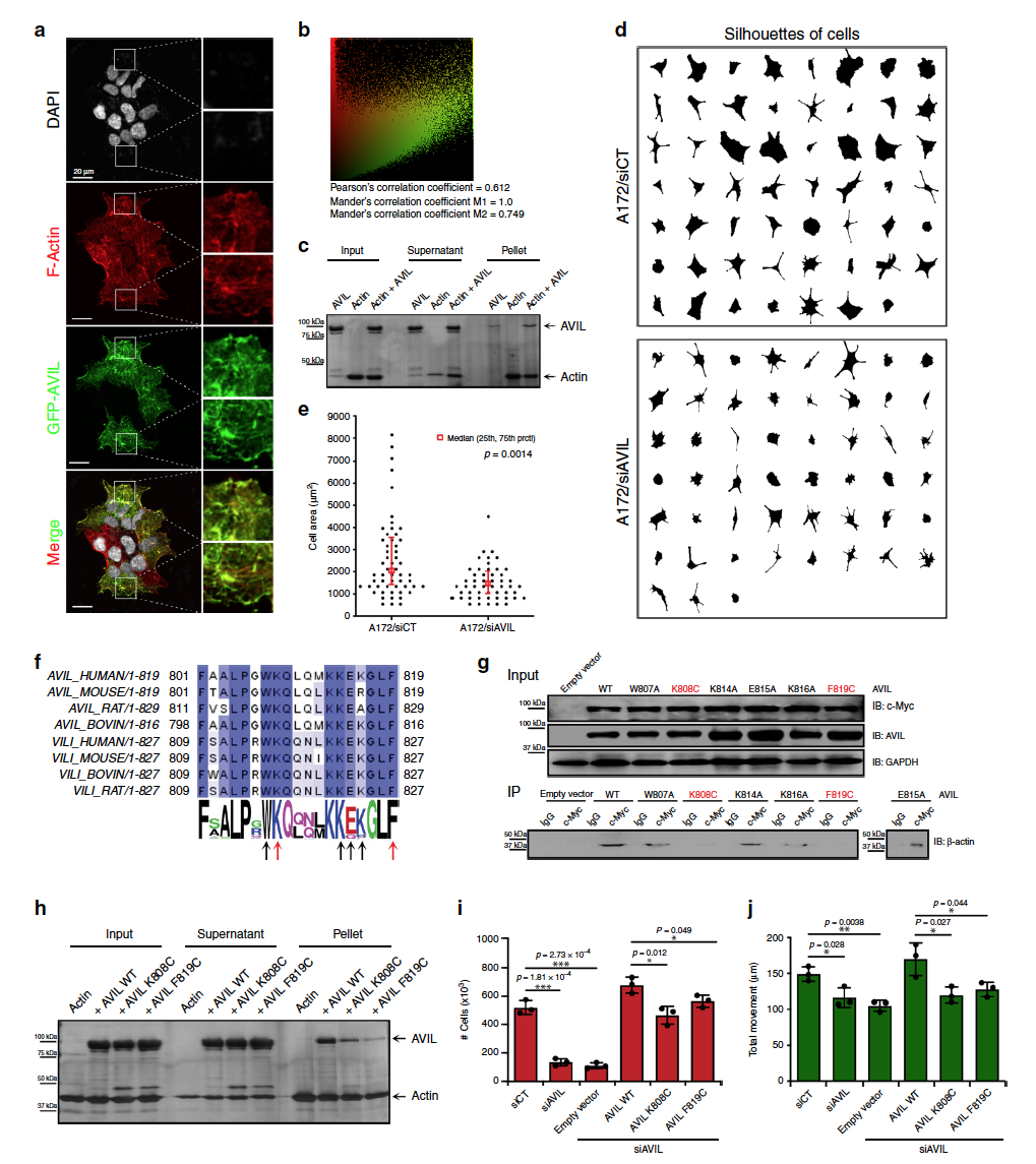 westr's tweet photo. Scientists ID gene responsible for deadly #glioblastoma: https://t.co/hVK6xBmFCb  #glioma #Actin #cytoskeleton #AVIL #FOXM1 #LIN28B

@NatureComms : https://t.co/2YQIyI2lj2  

"In this day and age, many people thought that all the significant #oncogenes have been discovered, .." https://t.co/zDM6jKKvkx
