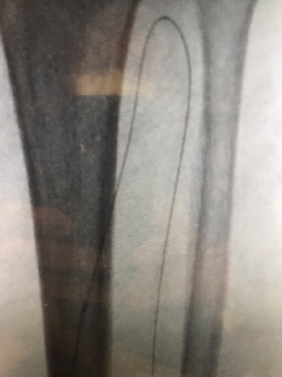 WilliamWuHVC's tweet photo. Pedal approach from At to PT and planta arc intervention.

80 y/ o lady with ischemic change  and ulcer at right heel.
She was found to have total occlusion at origin of PT. We got.  via right AT and  perform atherectomy balloon angioplasty to right PT, and planta arc https://t.co/f6V9Om2LtX
