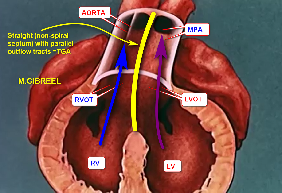 MGibreel1's tweet photo. Regarding the TGA 
i always say "TGA= aorta from RV".
Normally the septum that divides the conotruncus into LVOT/AO &amp; RVOT/PA should be spiral if being straight =TGA , if no septum at all=truncus arteriosus , if anterior cranial septal deviation=TOF, if there was defect=APW https://t.co/EvkCyrmrlD