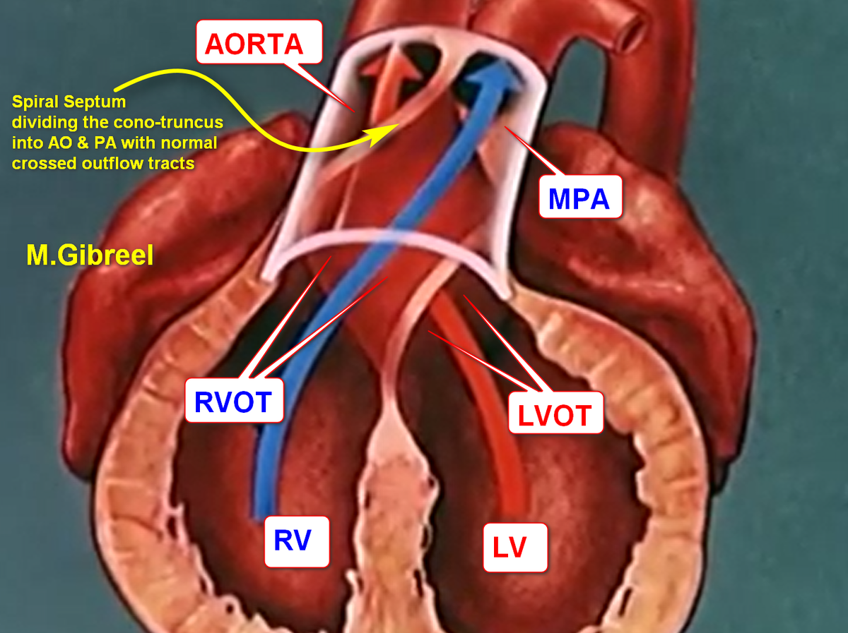 MGibreel1's tweet photo. Regarding the TGA 
i always say "TGA= aorta from RV".
Normally the septum that divides the conotruncus into LVOT/AO &amp; RVOT/PA should be spiral if being straight =TGA , if no septum at all=truncus arteriosus , if anterior cranial septal deviation=TOF, if there was defect=APW https://t.co/EvkCyrmrlD