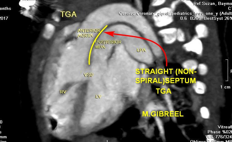 MGibreel1's tweet photo. Regarding the TGA 
i always say "TGA= aorta from RV".
Normally the septum that divides the conotruncus into LVOT/AO &amp; RVOT/PA should be spiral if being straight =TGA , if no septum at all=truncus arteriosus , if anterior cranial septal deviation=TOF, if there was defect=APW https://t.co/EvkCyrmrlD