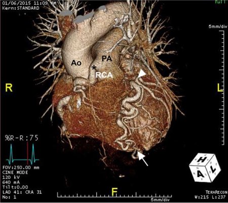 Texas_Heart's tweet photo. Anomalous Right Coronary Artery Arising from Pulmonary Artery in a Woman with Ventricular Dysfunction @ayeshas_MD @AliZaidiMD @MontefioreNYC | Texas Heart Institute Journal | Allen Press https://t.co/oCiLxab5bh https://t.co/xB0H4SdSGp