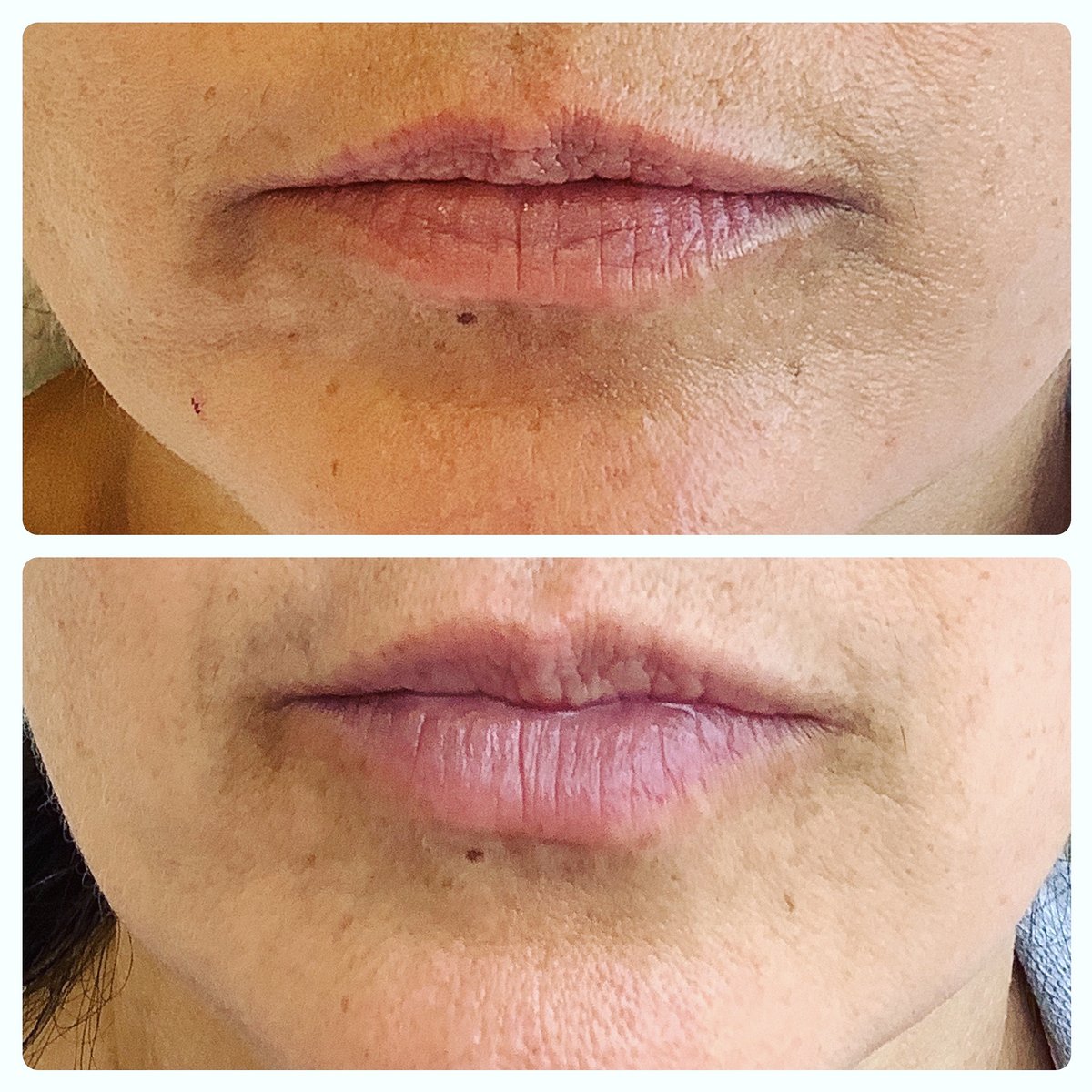 Gorgeous result adding a voluminous heart shape tip to the vermillion border with Versa Filler. Very natural, pouty and perfectly symmetrical look. 

#versa #lip #lipstick #eyebrows #primers #lipfiller #lips💋 #juicylips #lipliner #lovelips #lipgoals