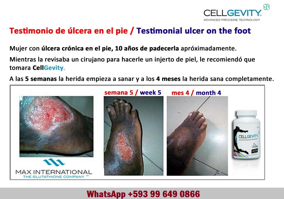 La #Riboceina (acelerador del #glutatión) y su poder #cicatrizante ayuda en la recuperación pie diabetico.

WhatsApp +593 99 649 0866

#RiboCeine #Glutathione #MaxOne #CellGevity