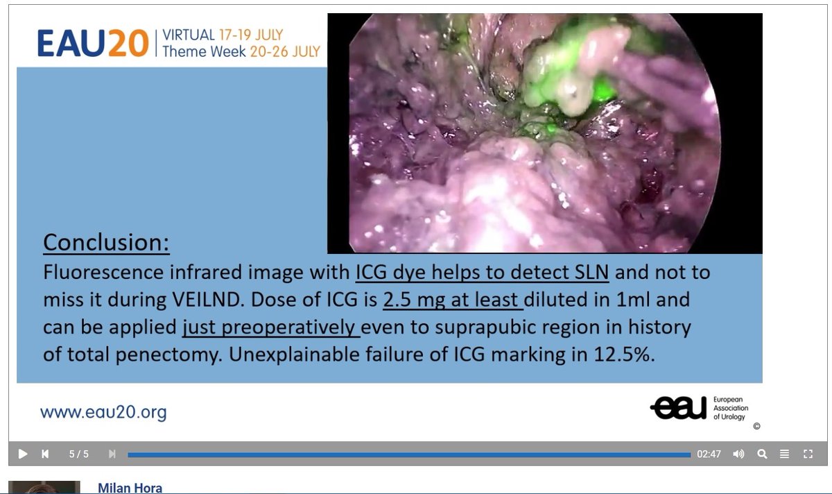 milanhoraplzen's tweet photo. VEILND (Video Endoscopic Inguinal Lymph Node Dissection) with florescence Indocyanine Green (ICG) marking of sentinel lymph node in penile cancer ≥ pT1G2 and cN0. @Uroweb Virtual congress EAU20. For registred: https://t.co/JbK5LJXMyf https://t.co/qLw7QXYEDc #uroczech https://t.co/q0Tb2e3276