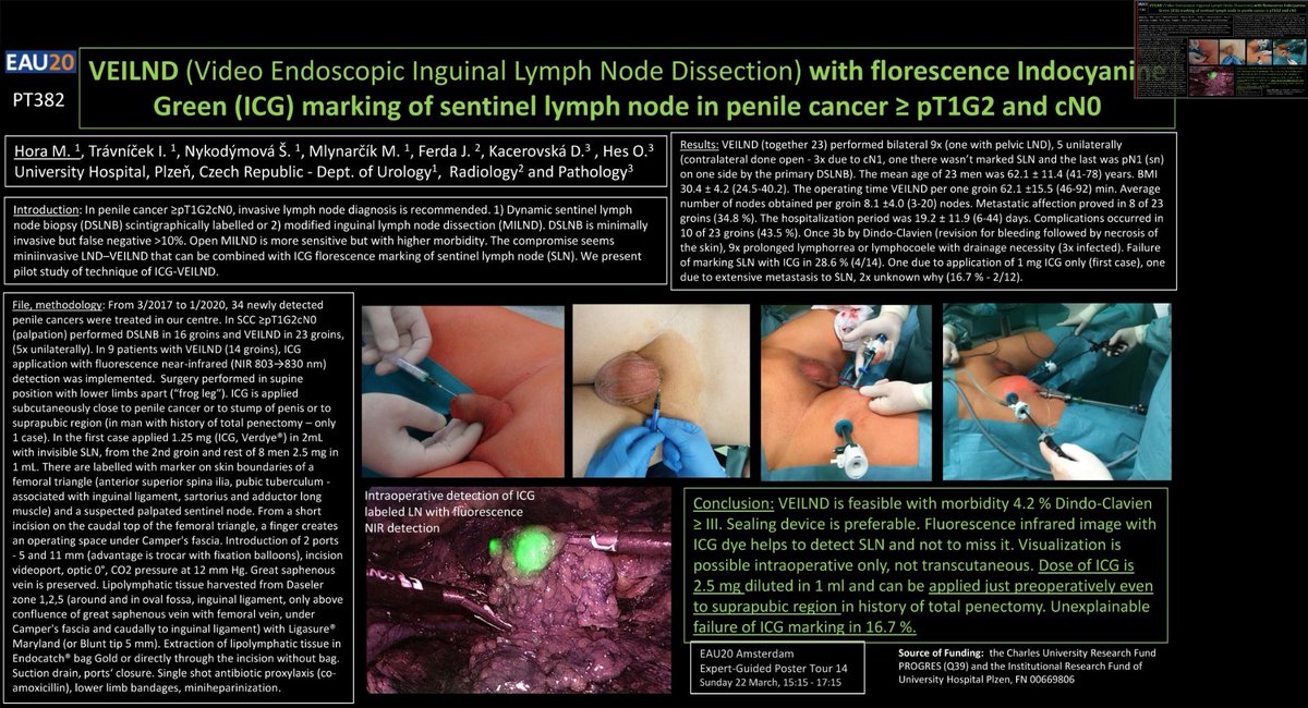 milanhoraplzen's tweet photo. VEILND (Video Endoscopic Inguinal Lymph Node Dissection) with florescence Indocyanine Green (ICG) marking of sentinel lymph node in penile cancer ≥ pT1G2 and cN0. @Uroweb Virtual congress EAU20. For registred: https://t.co/JbK5LJXMyf https://t.co/qLw7QXYEDc #uroczech https://t.co/q0Tb2e3276
