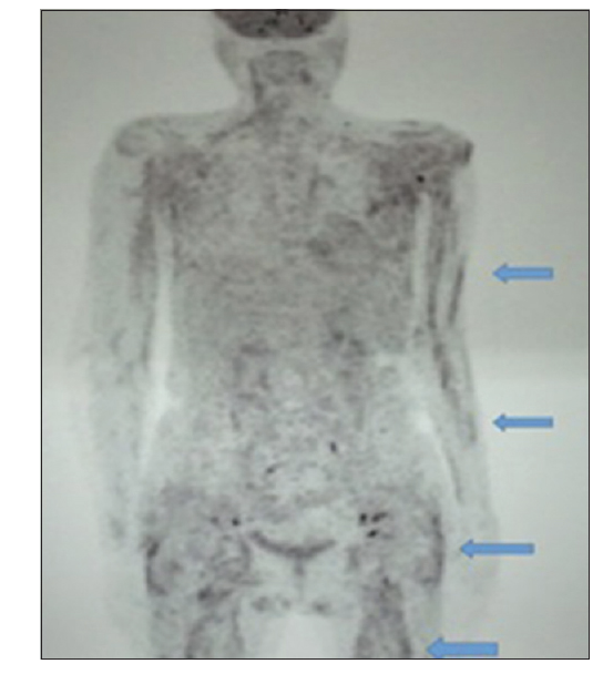 IJRheum's tweet photo. #Extrapulmonary #sarcoidosis presenting as #myositis: A rare case
https://t.co/s7LpB0yxNn
@TheMyositisAssc @MyositisI @MyositisSupport @UKMyositis https://t.co/XXXyTcWCBx