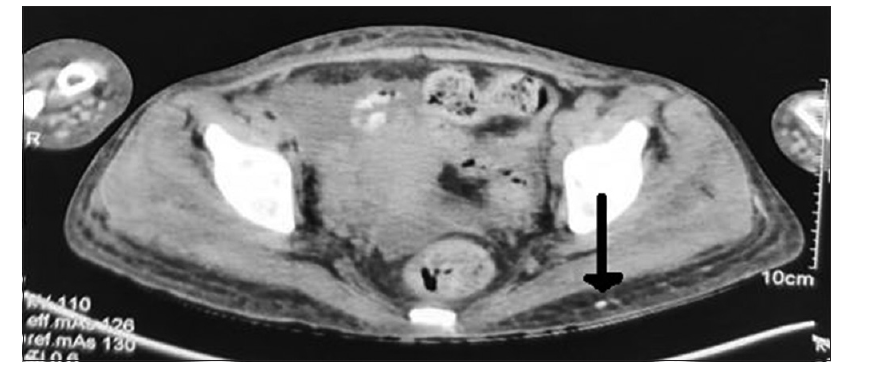 IJRheum's tweet photo. #Extrapulmonary #sarcoidosis presenting as #myositis: A rare case
https://t.co/s7LpB0yxNn
@TheMyositisAssc @MyositisI @MyositisSupport @UKMyositis https://t.co/XXXyTcWCBx
