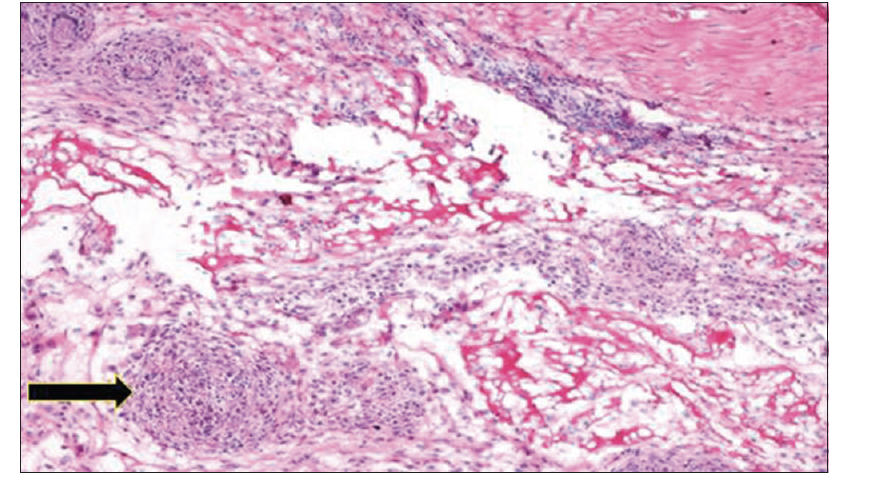 IJRheum's tweet photo. #Extrapulmonary #sarcoidosis presenting as #myositis: A rare case
https://t.co/s7LpB0yxNn
@TheMyositisAssc @MyositisI @MyositisSupport @UKMyositis https://t.co/XXXyTcWCBx