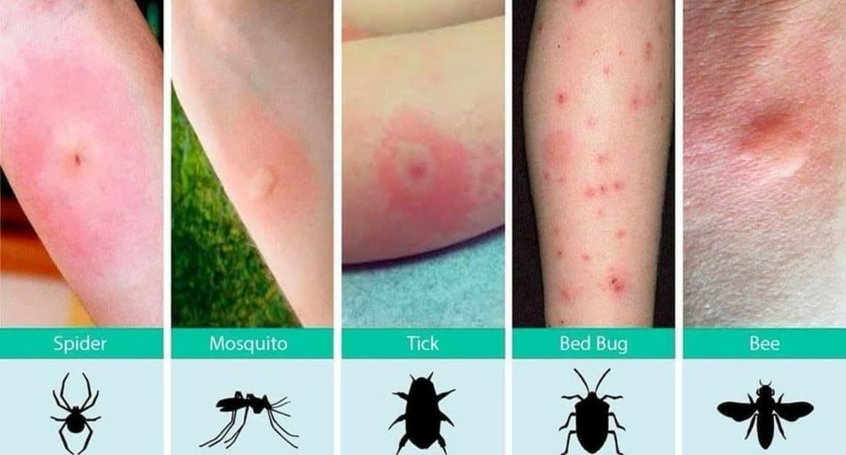 GeologyOfficial's tweet photo. Identify common insect bites
#geology #fieldtips #geologybuzz https://t.co/sACEFHlEps
