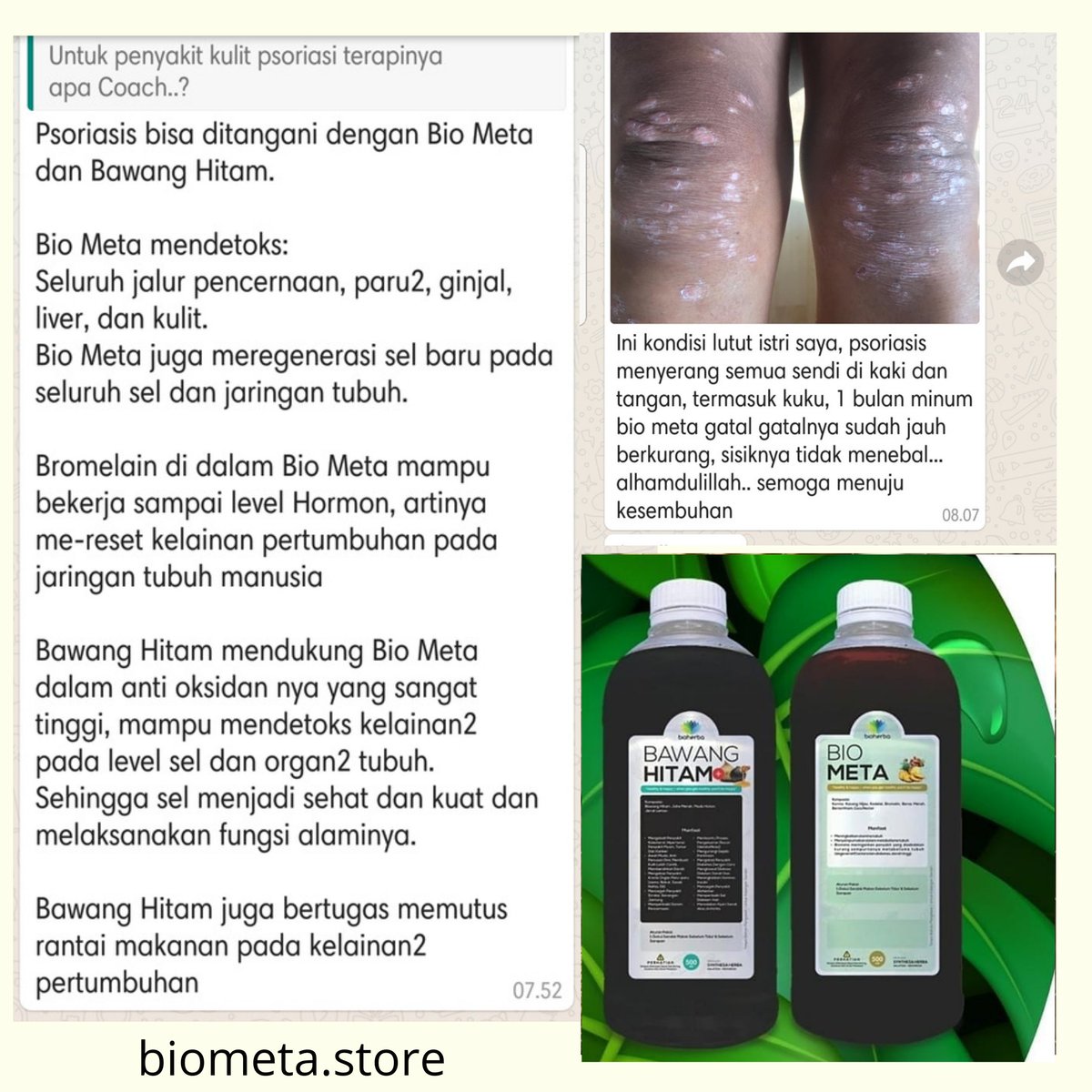 BIOMETA2's tweet photo. PSORIASIS, SEBAB DAN BENTUK PENYAKITNYA

Psoriasis adalah penyakit autoimun yang mengenai kulit, ditandai dengan sisik yang berlapis berwarna keperakan, disertai dengan penebalan warna kemerahan dan rasa gatal atau perih. Bila sisik ini dilepaskan maka akan timbul bintik https://t.co/vdqKx3xie6