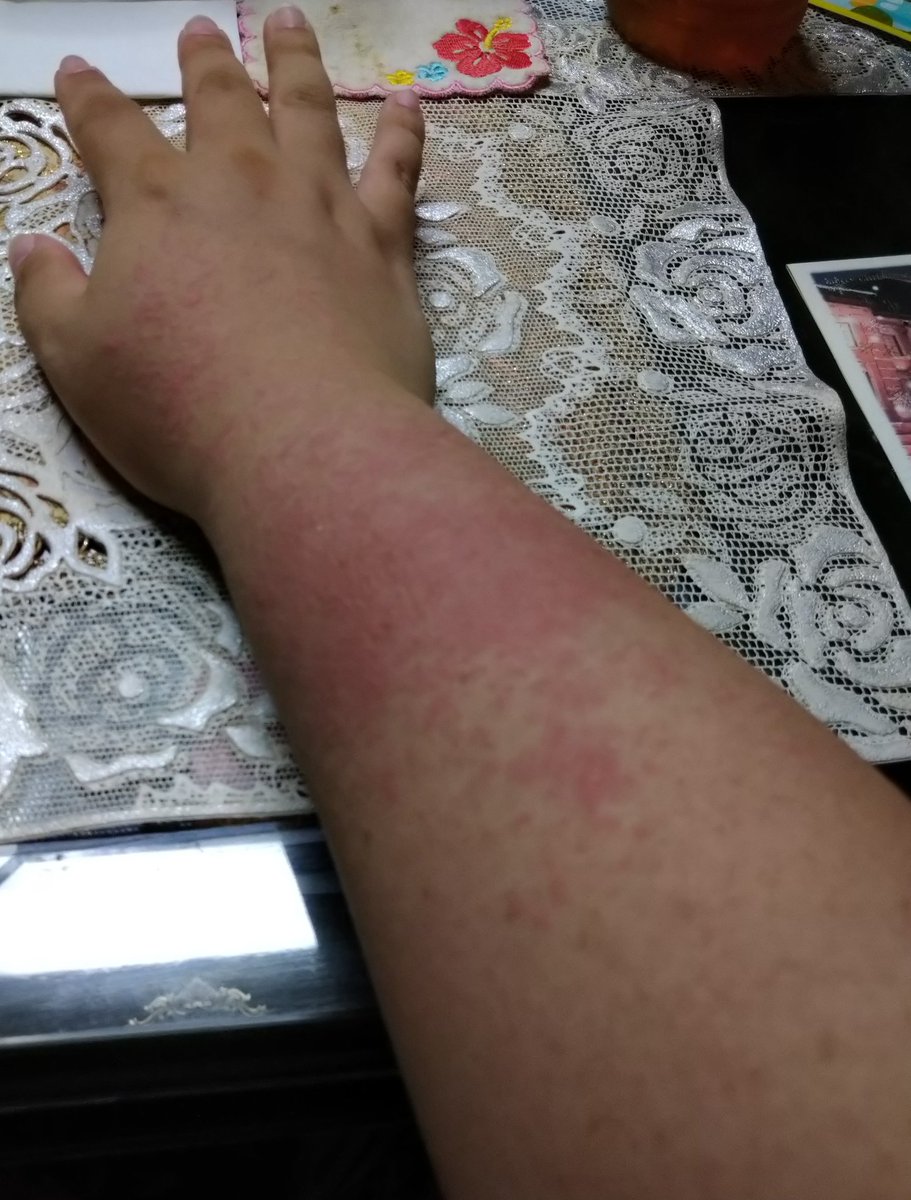 日光湿疹 Twitter Search