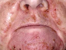 An interesting skin manifestation of a rare neuroendocrine tumour Glucagonoma  called necrolytic migrating erythema (NME). The main presentations of this tumour  are diarrhoea, symptoms of diabetes and skin manifestation of NME as in this photograph.