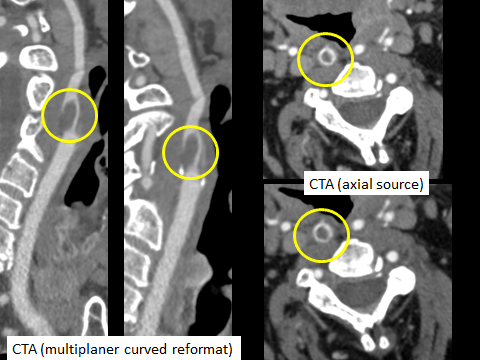Hammerdongle's tweet photo. Dick's Pick of the Week: Carotid Intraluminal Thrombus

Imaging findings: Intraluminal filling defect completely surrounded by contrast on two contiguous axial source images "donut sign".  

#FOAMed #FOAMrad #radres #NeuroRad #radiology #Neurology https://t.co/MWCIcwxHmi