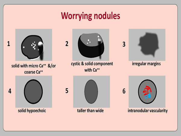 Worrying thyroid nodules.