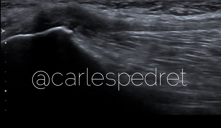 About a thread here in tweeter from some time ago, here I show you another proximal #enthesopathy of the TFL on the ASIS (longitudinal #ultrasound )

It is a much more common entity than people may think. Patient show the exact point of pain.

Not all is greater trochanteric pain