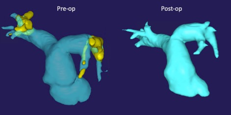NimeshDesaiMD's tweet photo. Massive Pulmonary Embolism with hemodynamic instability 24hrs post partum.  Near total occlusion of both PA’s and MASSIVE clot burden.

Emergent open embolectomy.  Patient walked out of the hospital! 

Key: MUST retroflush pulm veins/ squeeze out lungs to expell ALL the clot https://t.co/BcXQQJLH0k