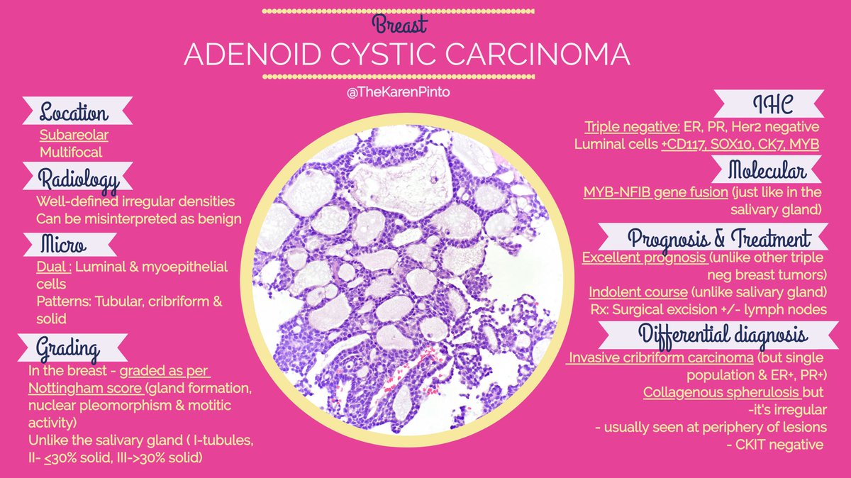 All you need to know about adenoid cystic carcinoma ( #ACC) of the breast 
 
Looks the same as the one in the salivary gland but when in the breast, it has an excellent prognosis 

#pathology #BreastPath