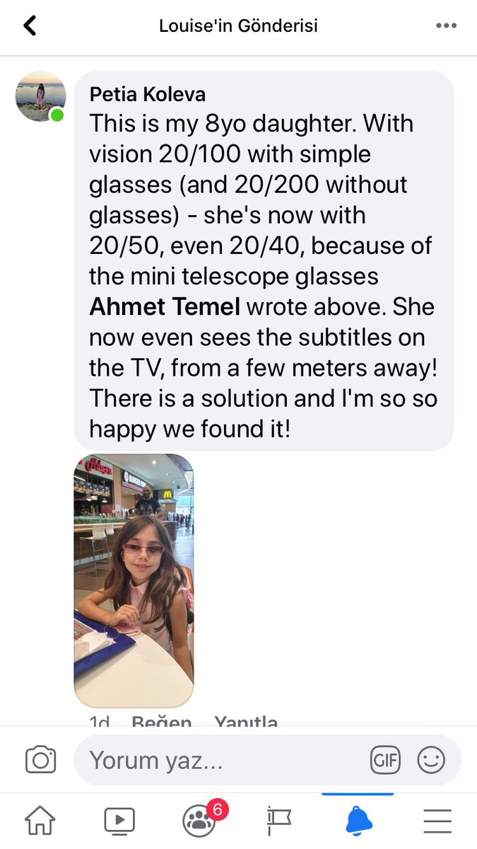 azgorme's tweet photo. There is an excellent brand new technique and spectacle (MiniTelescopicGlasses) that works great in #OA, #ConeRodDystrophy, #Stargarts cases; initial three x better vision with an invisible spectacle; good in distance and near vision both https://t.co/hRE32I3Udy