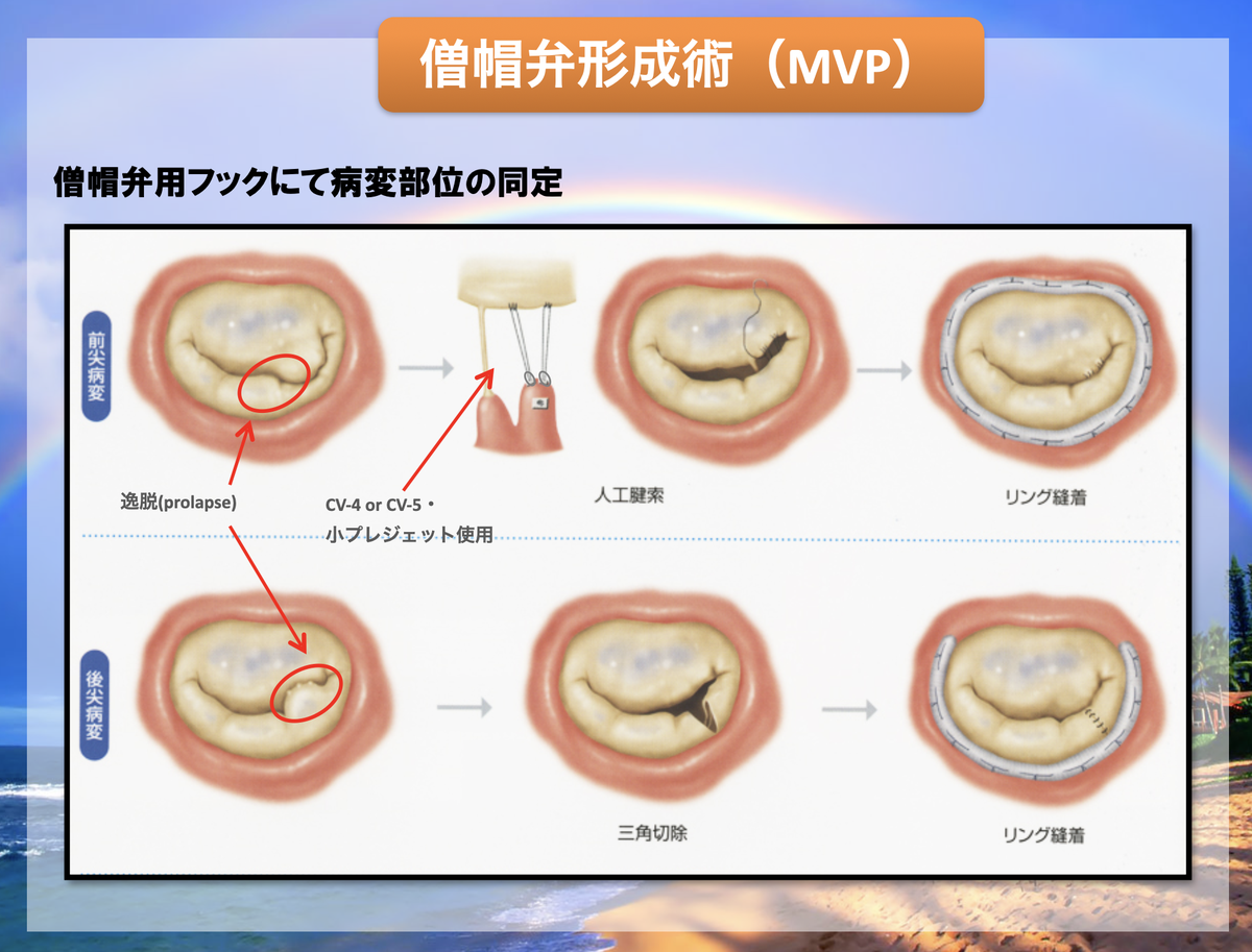 Nbaku_mn's tweet photo. 僧帽弁って、かわいくないですか？
なんか、どうみてもスマイルマークににえませんか？
目のないスマイル。
要はこのスマイルを美しく保てなくなる状態が、僧帽弁の逸脱や前尖と後尖の接合が悪くなってる状態です。
形成方法はご覧の通り、スマイルの復活です。
超可愛くないですか？
#Nオペ https://t.co/Wdd5CZmPCP