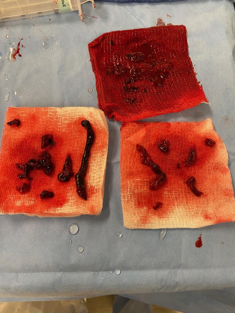 Adnan Alexander Kassier, MD. FACC. FSCAI (@akassier) on Twitter photo Let's get some clots out. <a href="/InariMedical/">Inari, now part of Stryker</a> #FlowTriever #thrombectomy
Pre PAP 50/21/32
Post PAP 23/10/16
Great results. Immediate improvement in sx. Sats up from 87 to 100 %
<a href="/Ascension_MI/">Ascension Michigan</a> <a href="/TimAFischellMD/">Tim A. Fischell, M.D</a> Let's get some clots out. <a href="/InariMedical/">Inari, now part of Stryker</a> #FlowTriever #thrombectomy
Pre PAP 50/21/32
Post PAP 23/10/16
Great results. Immediate improvement in sx. Sats up from 87 to 100 %
<a href="/Ascension_MI/">Ascension Michigan</a> <a href="/TimAFischellMD/">Tim A. Fischell, M.D</a>