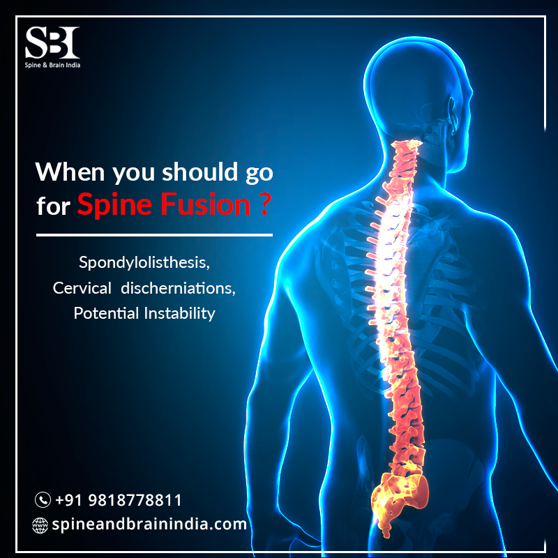 spinebrainindia's tweet photo. Spinal fusion is a surgical procedure used to correct problems with the small bones in the spine (vertebrae). It's essentially a "welding" process. The basic idea is to fuse together two or more vertebrae so that they heal into a single, solid bone. #cervical #spinalfusion #spine https://t.co/OdJtNBONnF