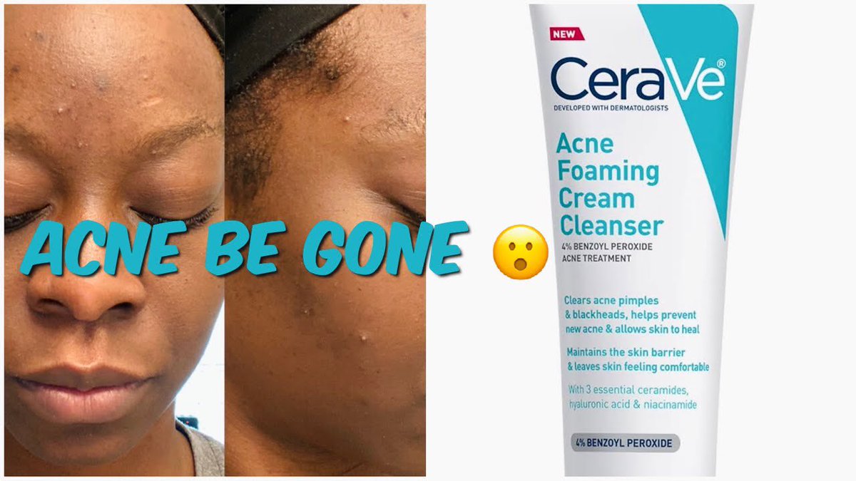 cerave sa smoothing cream acne