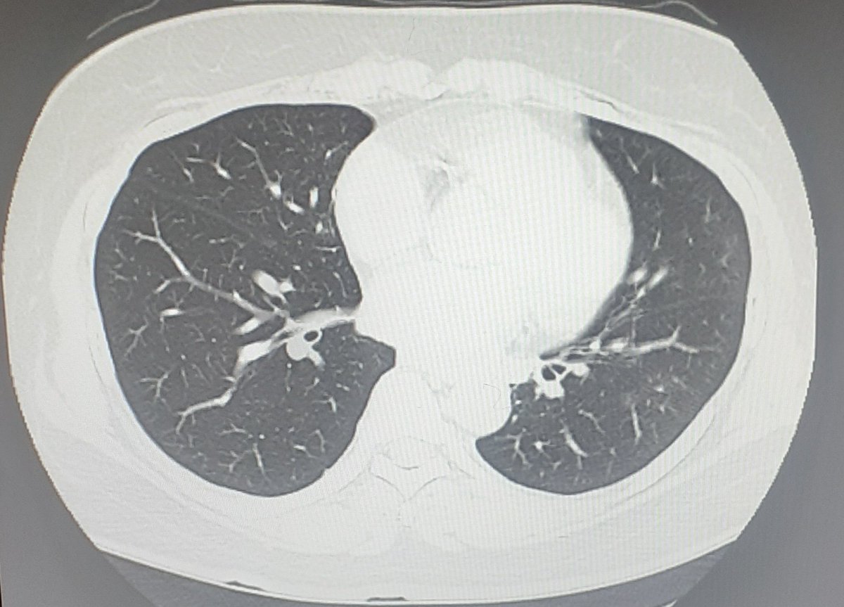 dirgarambe's tweet photo. FENOMENA "LONG COVID":

- Makin byk pasien #COVID19 dinyatakan sembuh, msh merasakan gejala hingga 2-3 bulan
- Keluhan: sesak, mudah lelah, nyeri sendi, sulit konsentrasi, dll
- Kualitas hidup menurun
- Efek jangka panjang blm sepenuhnya diketahui
- Bukan penyakit biasa
- Cegah! https://t.co/NXSXQ2k2h6