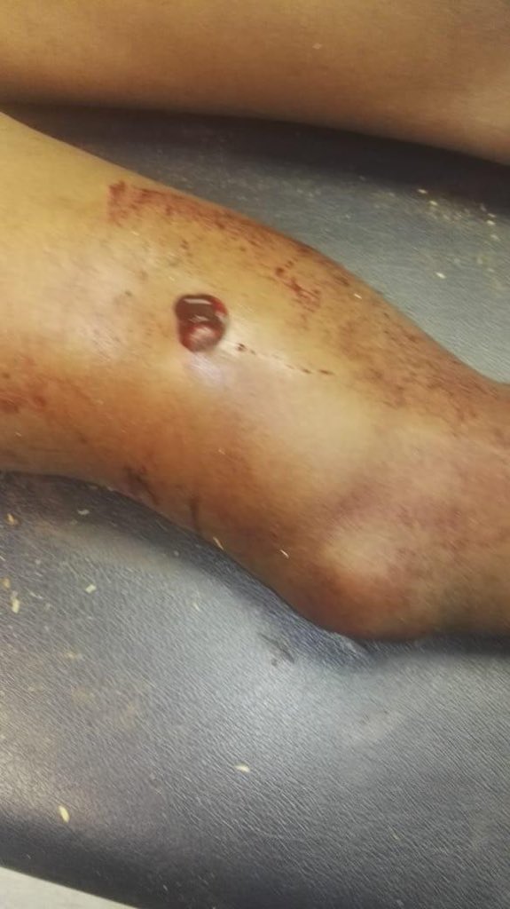 sensei_msquared's tweet photo. Yesterday the @SAPoliceService almost killed my big brother in MP kwamhlanga. They went in he’s place with no warrant,they beat him up and kidnapped him and threw him in the bushes after thinking they killed him. We found him there in the bushes handcuffed and shot🙆🏽‍♂️🙆🏽‍♂️🙆🏽‍♂️@News24 https://t.co/z5LkHxrpBY