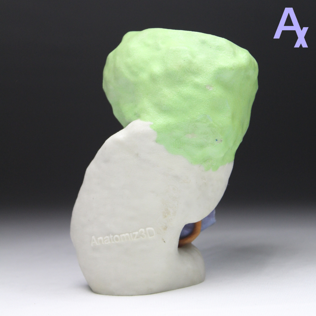 Anatomiz3D's tweet photo. The medical team was able to achieve clarity with the help of 3D printed model in the case of kidney tumour. They were not sure whether half of the affected kidney could be saved by performing partial Nephrectomy but 3D model guided them in showing it was achievable.

#3DPrinting https://t.co/pU6RykNbjZ