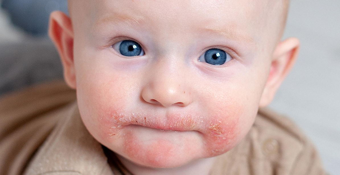 ScienceMagazine's tweet photo. Children with colonies of the bacteria Stapylococcus aureus on the skin 6 months after birth could be at higher risk of developing #eczema by the age of 2, according to a new study from @ScienceTM. #atopicdermatitis #dermatology https://t.co/DGSsnXA481

Credit: Leadenpork/iStock https://t.co/RXm7cEEBD8