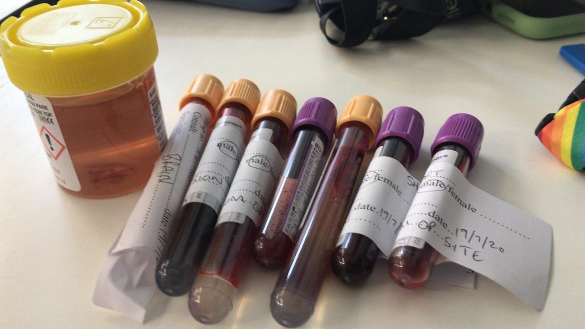 Excited to enroll the first patient in SHIBA (Severe Head Injury Brain Analysis) - trauma biopsy <a href="/shu_hasan/">Shumaila Hasan </a> <a href="/RlhNeurosurgery/">RLH Neurosurgery</a> @RoyalLondonHosp <a href="/NHSBartsHealth/">Barts Health</a> <a href="/QMUL/">Queen Mary University of London</a> 5 years and  doi.org/10.1155/2019/9… in the making!