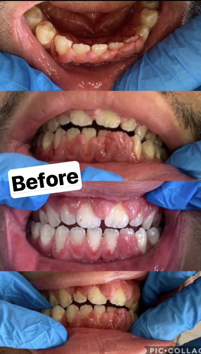 nourhan0mostpha's tweet photo. I miss my work 🦷 #dentistry #gingivectomy free hand just by luncet and blade 13B 😭 i miss my work gdnnnn b2aaa🥺 https://t.co/w8XtnqNb50