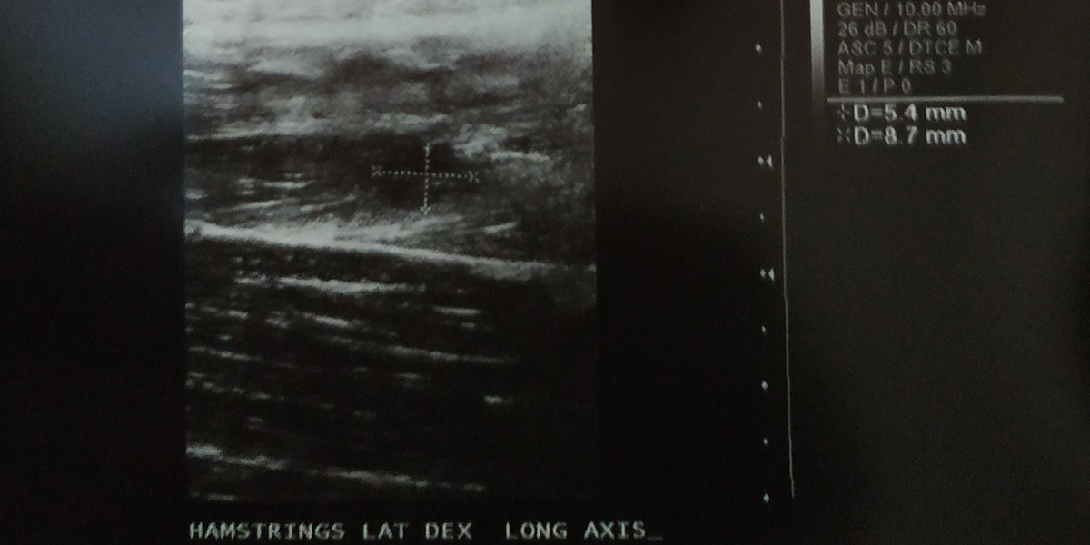 DrJakovljevicMD's tweet photo. Nogometašica (14 godina). Ruptura mišića stražnje lože desne natkoljenice.
14 years old female football player. Hamstring muscle tear.
#mskultrasound #sportsinjuries #hamstring #muscletear https://t.co/hV3v8kdUzD