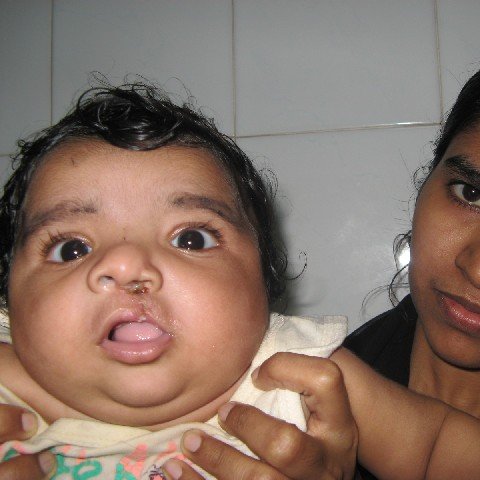 AndeiSoI's tweet photo. Pre-op  and Post-op pic of a cleft baby with mom #cleftrepair #cleftsurgery #lovewhatido #lovemyjob #drsunilrichardson #maxfax https://t.co/OuXeRpEroM