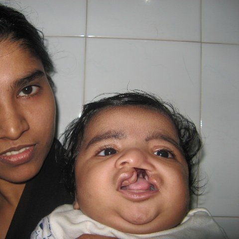 AndeiSoI's tweet photo. Pre-op  and Post-op pic of a cleft baby with mom #cleftrepair #cleftsurgery #lovewhatido #lovemyjob #drsunilrichardson #maxfax https://t.co/OuXeRpEroM